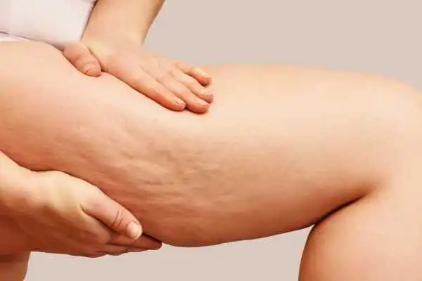 Image of woman showing leg with cellulite Byfleet