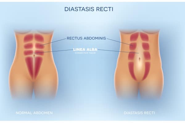 What Non-Surgical Options Are Available for Diastasis Recti Byfleet?