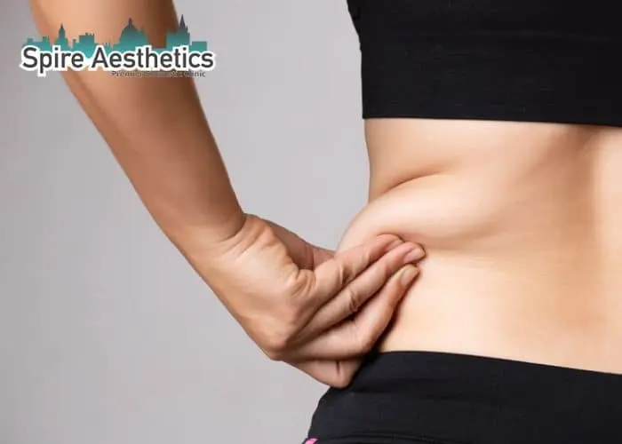 Image of woman pinching fat on their hips Byfleet. Fat Freezing treatment 
