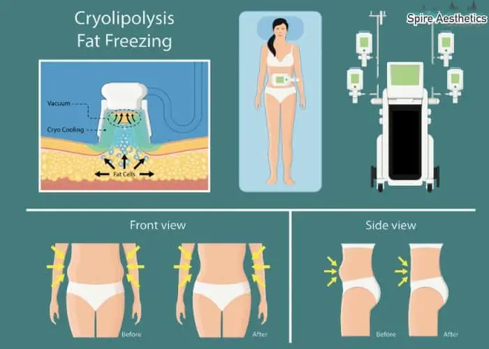 Fat freezing treatment Byfleet benefits for competitions to remove stubborn fat deposits.