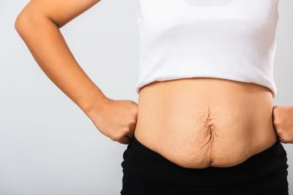 Image of a woman's stomach after weight loss with sagging skin following a gastric band Byfleet